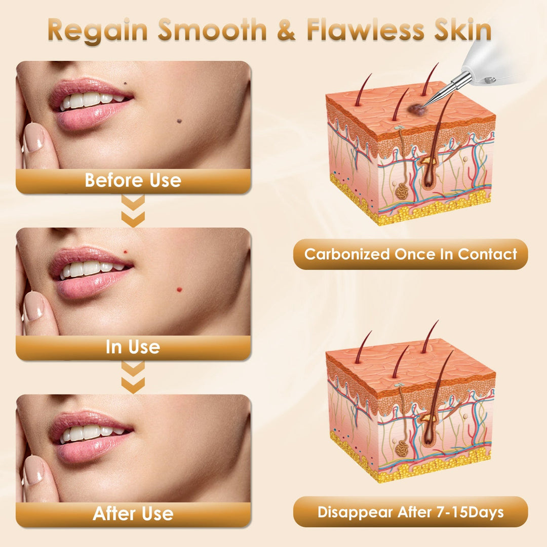 Portable Skin Tag Remover Pen with LED Light 9 Intensity Gears Cordless Rechargeable Skin Tag Removal Kit Intended for Common Warts Mole Skin Tags Gif